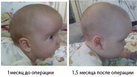 Deformitet av skallen hos nyfødte, barn, med setepresentasjon. Tegn, symptomer, hvordan fikse