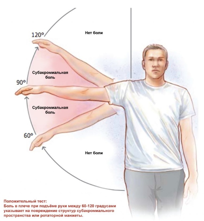 Subacromial shoulder impingement syndrome. Symptoms, treatment, degrees