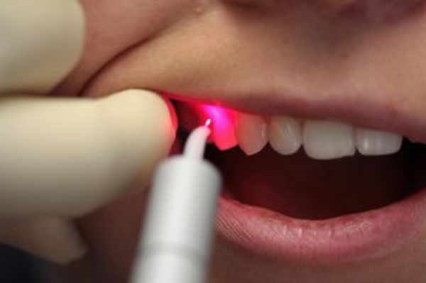 Tratamento com laser da doença periodontal. Avaliações, preço, contra-indicações