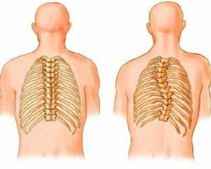skolioza in skoliotična drža