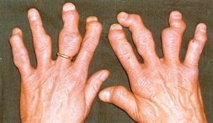 postižených psoriatických prstů