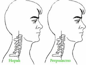 modificări ale coloanei vertebrale