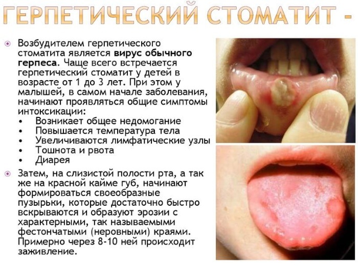 Herpes stomatitis. Treatment in adults, consequences, incubation period