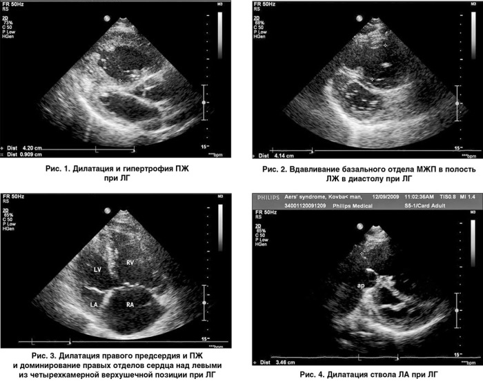 Echocardiography of the heart in adults. Decoding, norm in the table
