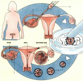 Langkah pertama dalam memerangi infertilitas