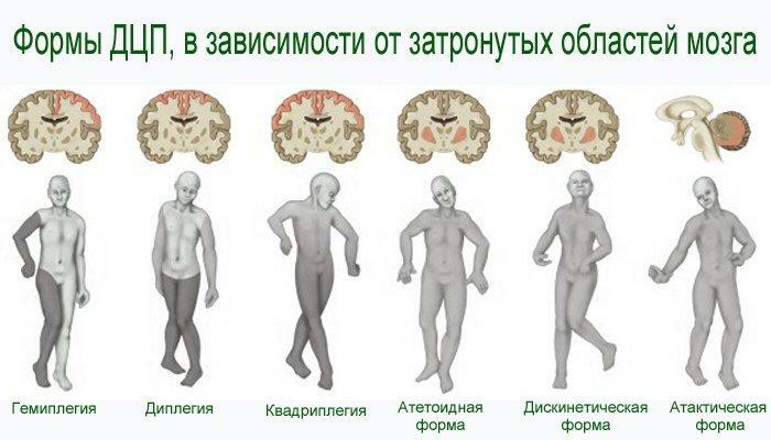 De former av cerebral parese, beroende på de drabbade områdena i hjärnan
