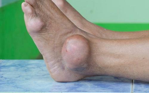 Gout on legs - photo