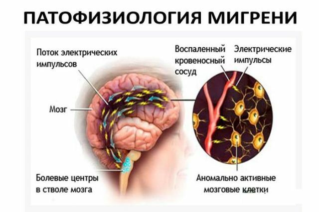 Patofysiologi af migræne