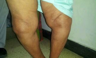 Deformarea artrozei genunchiului