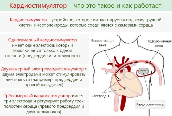 Pacemaker. What is it, photos, views, how it works, how much it costs, the installation operation is set, life with him