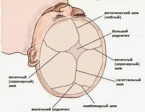 Sutura metópica na testa em uma criança, craniostenose em crianças. Taxa, tratamento