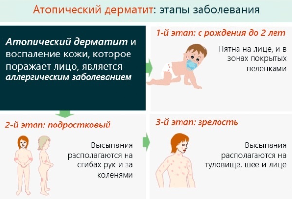 Dermatitis en los niños. Imagen, síntomas y tratamiento de contactos, alérgica, perianal, pelonochny, atópica